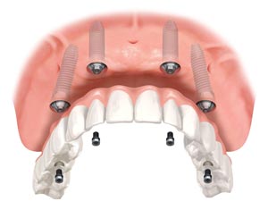 Implante Dentário